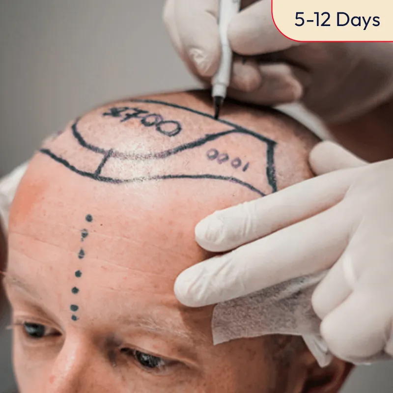 hair-transplant-site-prep-e1732891703489-3.jpg