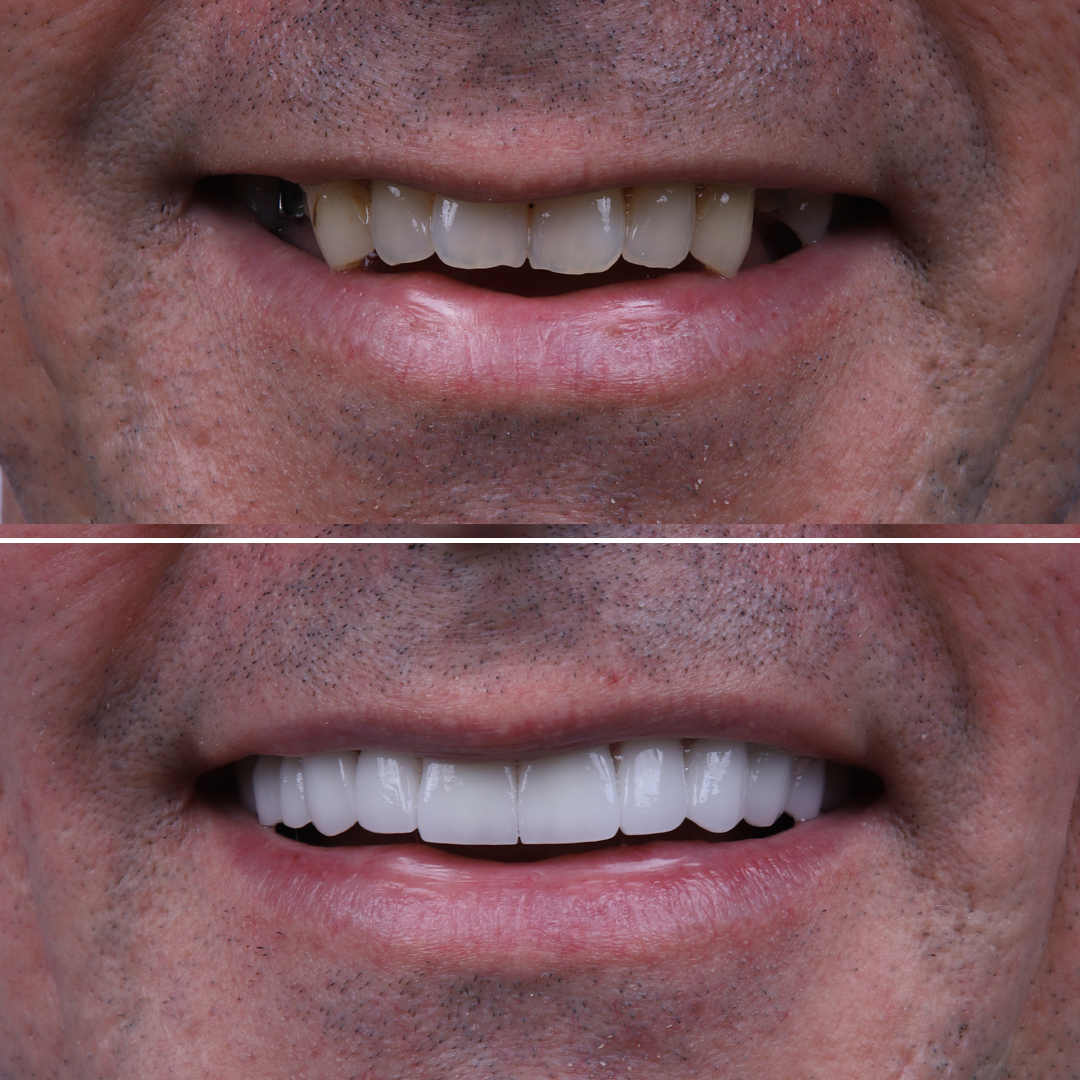 Smile makeover using dental implants for heavily stained teeth