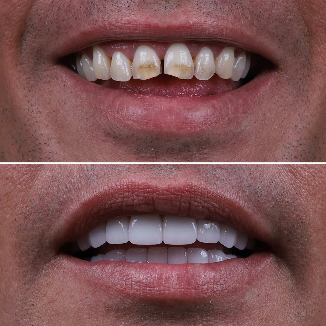 Male patient before and after full-arch dental implant and veneer treatment
