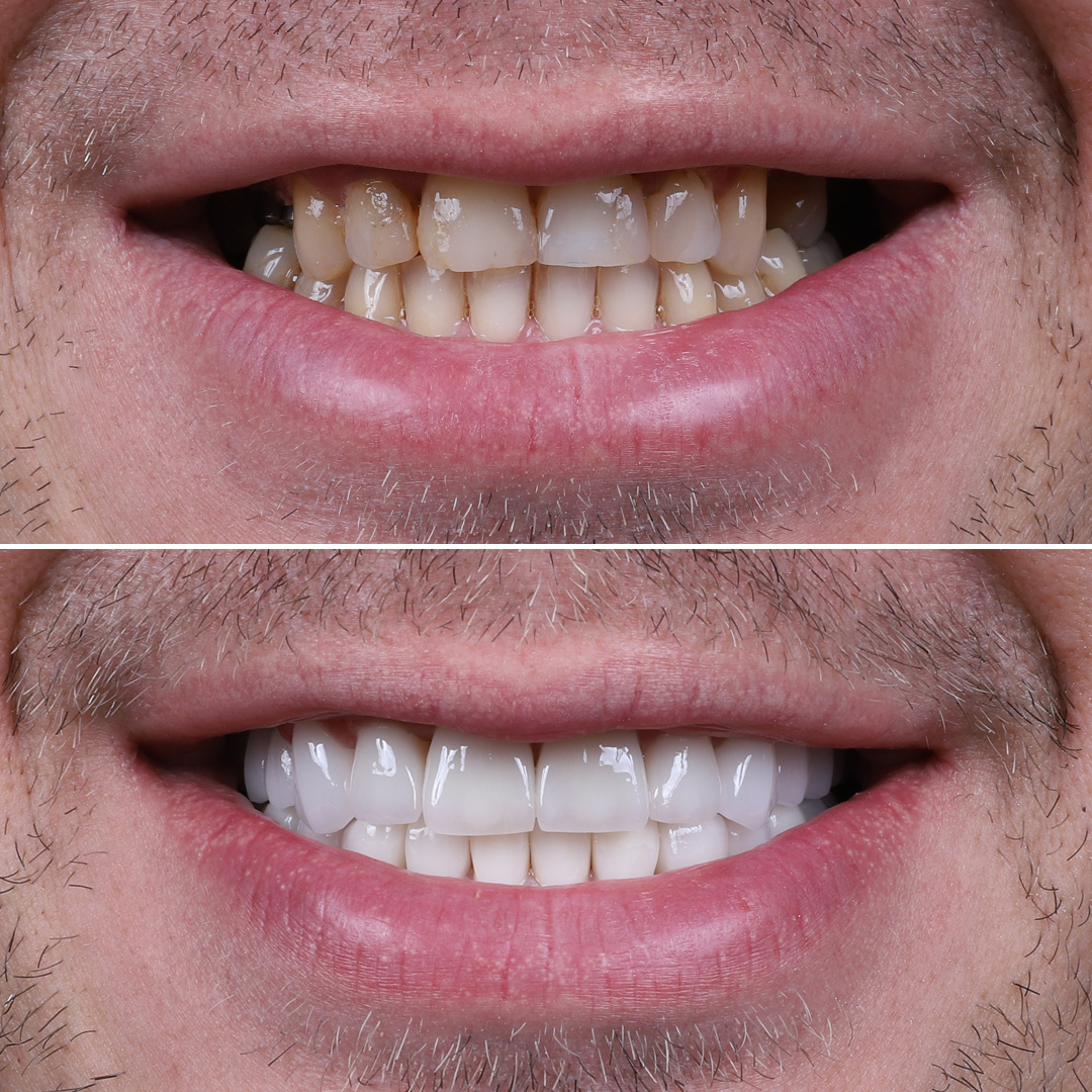 Lower jaw dental implants before and after transformation