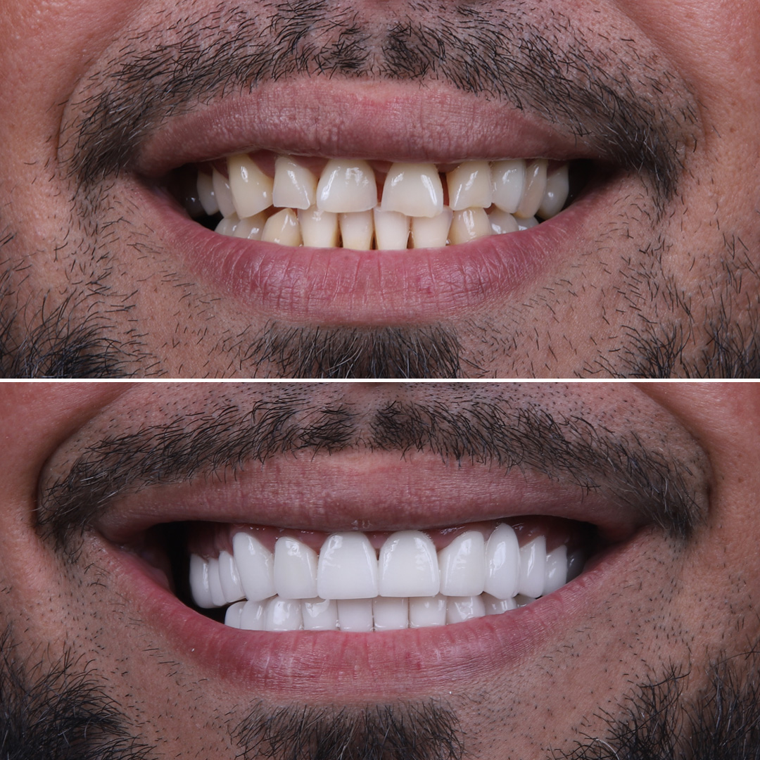 Full mouth dental implants before and after – male patient