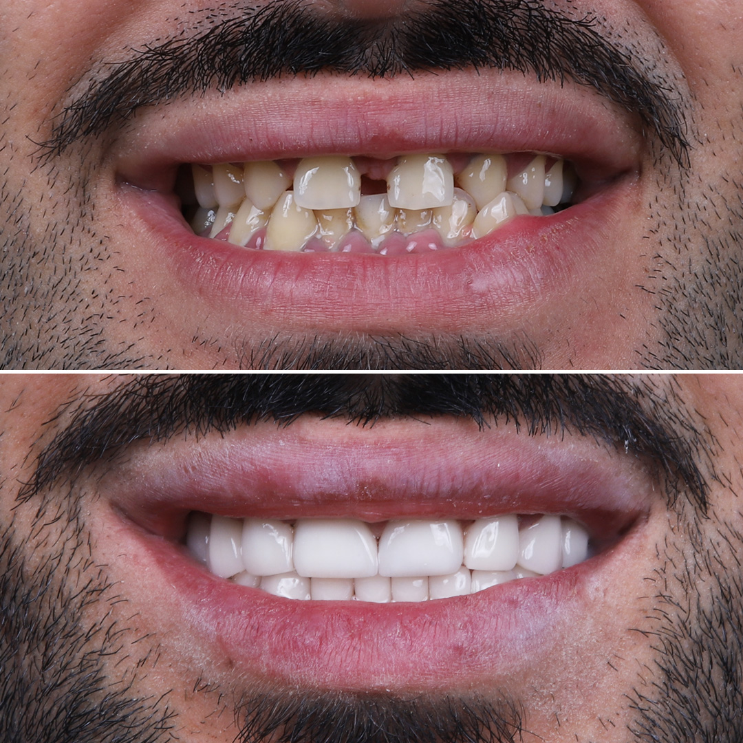 Male patient before and after dental implant-supported crowns for front teeth