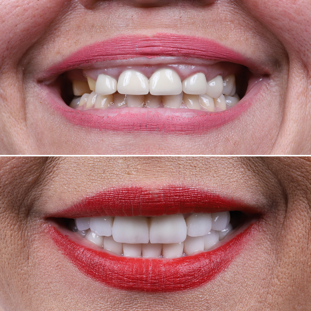 Female patient before and after full dental implant treatment with smile makeover