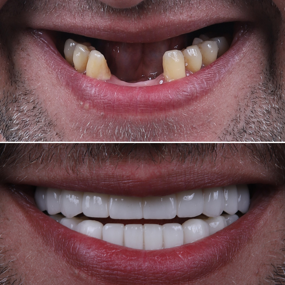 Full upper arch restoration with All-on-4 dental implants