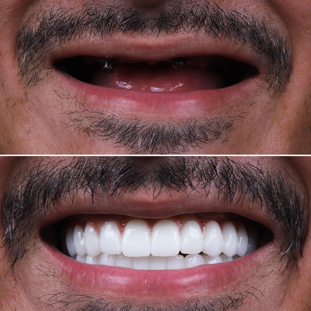 Before and after missing front tooth implant replacement