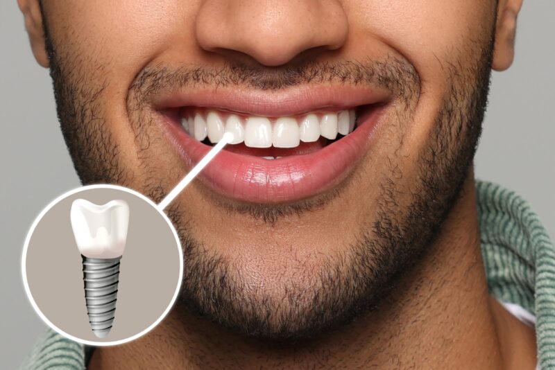 Close-up of a smiling man with a dental implant illustration highlighting the restored tooth.