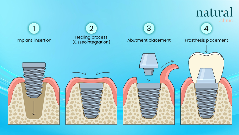 Step-by-step illustration of dental implant treatment process showing implant post, abutment, and crown placement