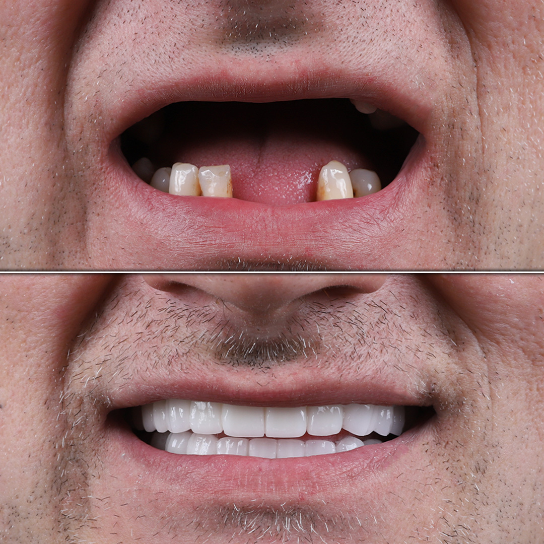 Severely damaged and missing front teeth restored with implants – male patient