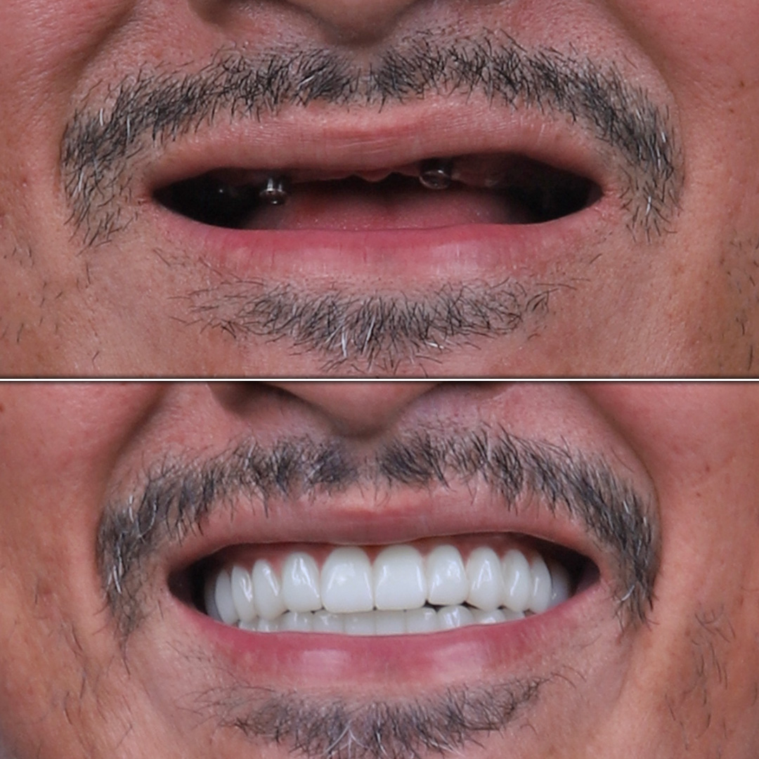 Full upper dental implants for a toothless male patient – before and after