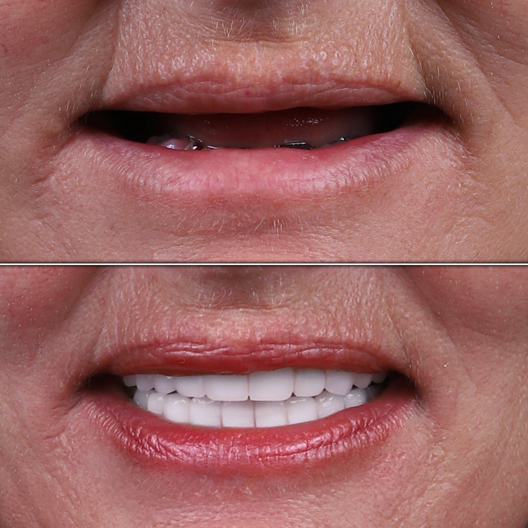 Older female with missing upper teeth receives full implant-supported restoration