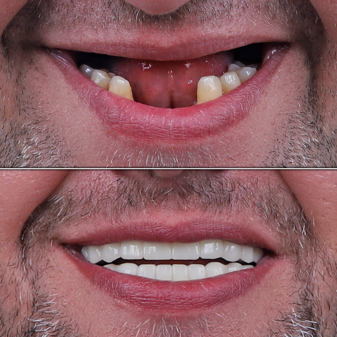 Multiple implant-supported restorations in a male patient – before and after
