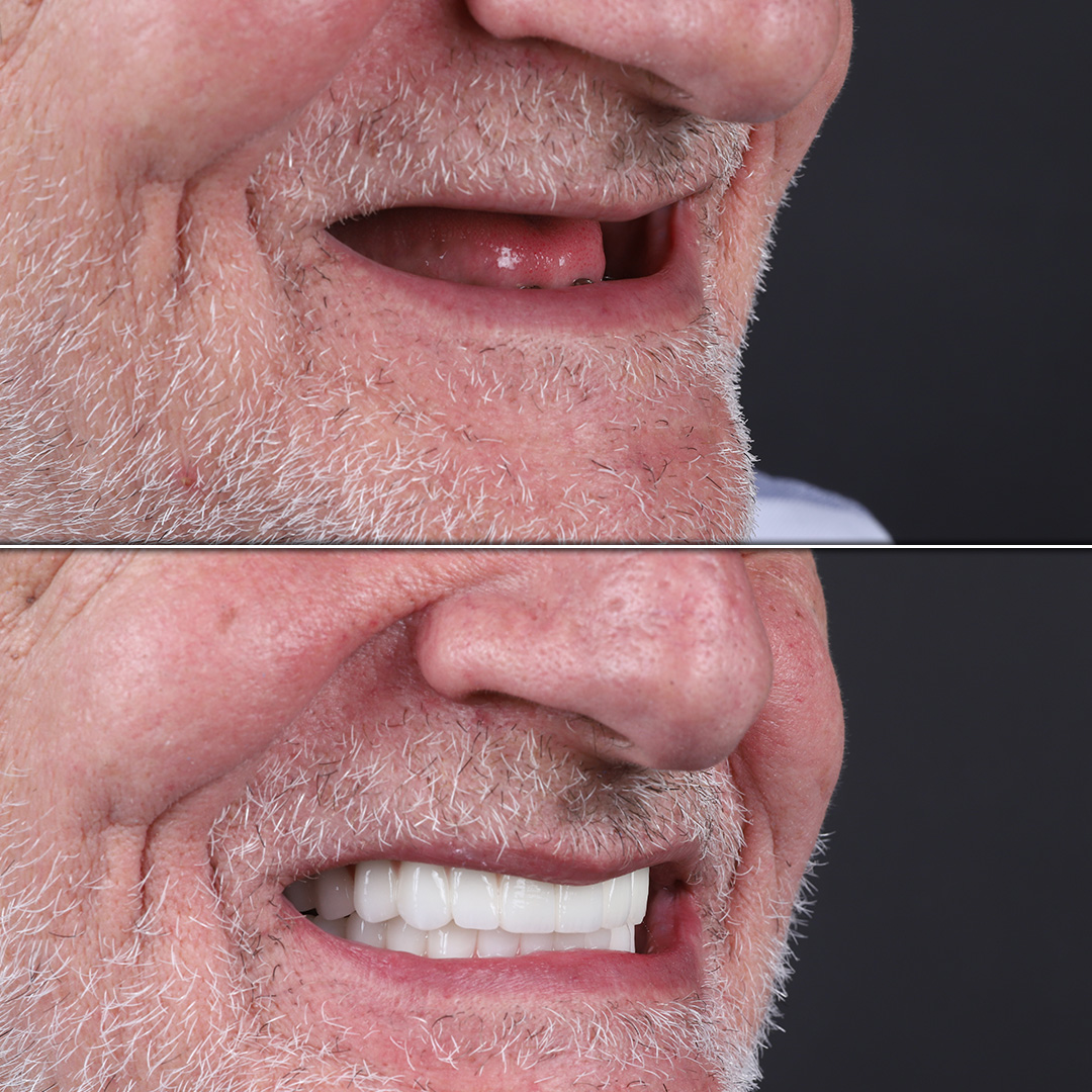 Senior male patient receives full-arch implant-supported teeth