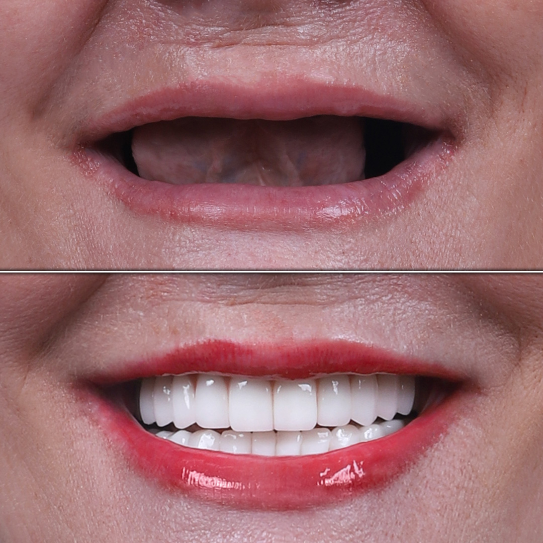 Before and after full mouth dental implants in a female patient
