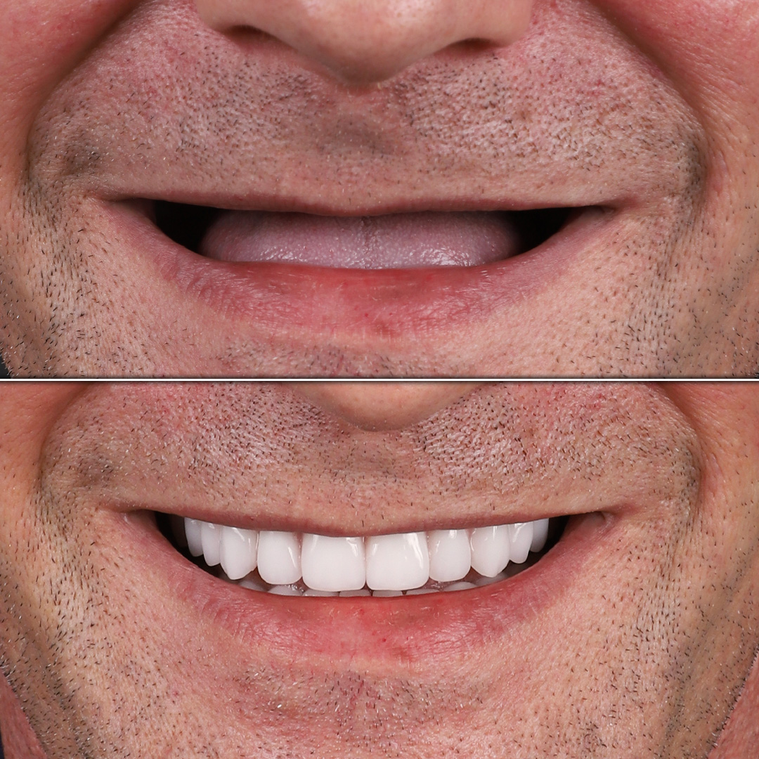 Upper jaw edentulism treated with implant-supported fixed prosthesis