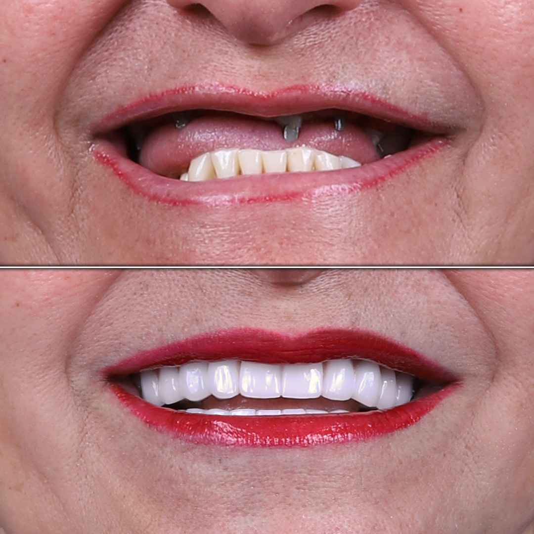 Male patient before and after upper jaw dental implants