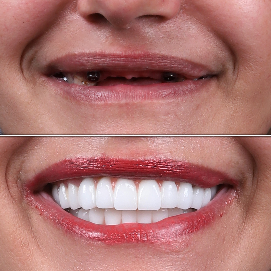 Young female smile transformation with multiple dental implants