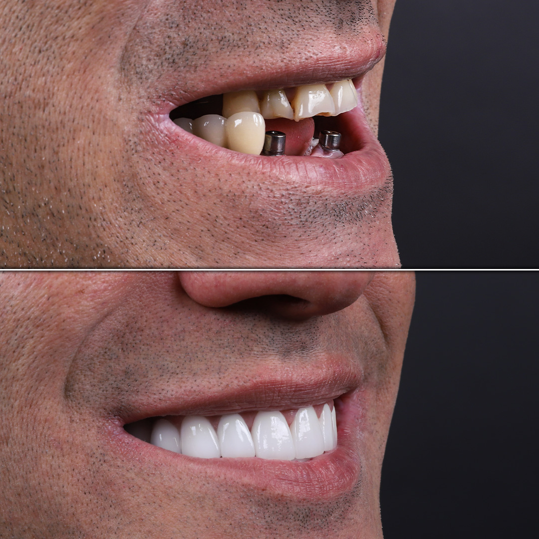 Side profile showing implant-supported smile makeover in male patient