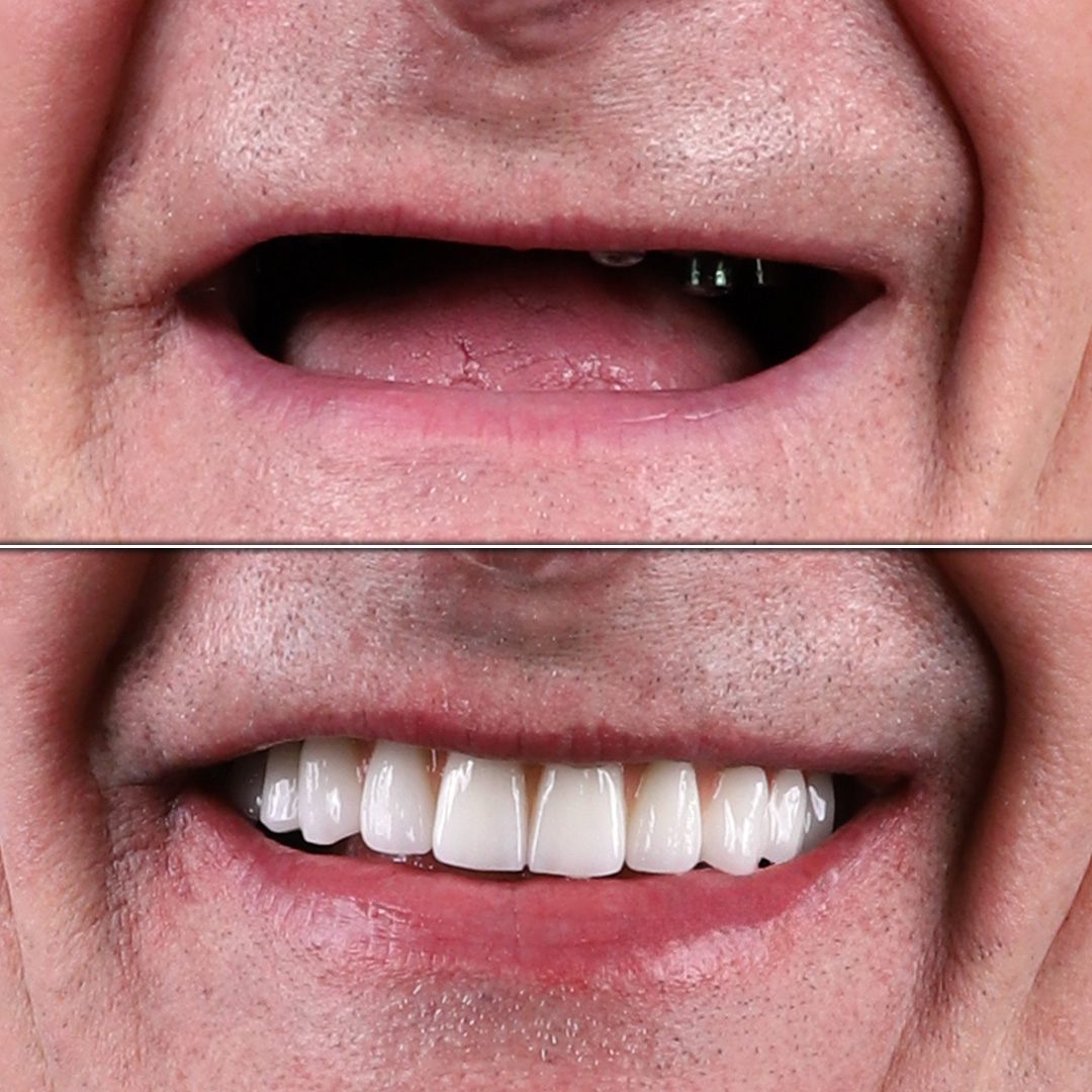 Full edentulism resolved with complete implant dentures – before and after