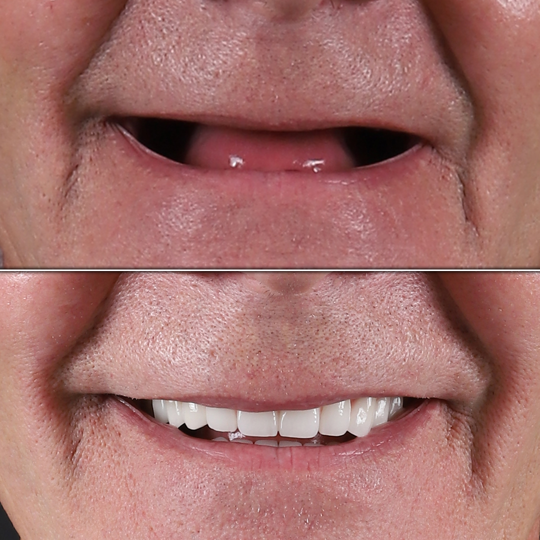 Before and after full dental implant restoration in an edentulous male patient