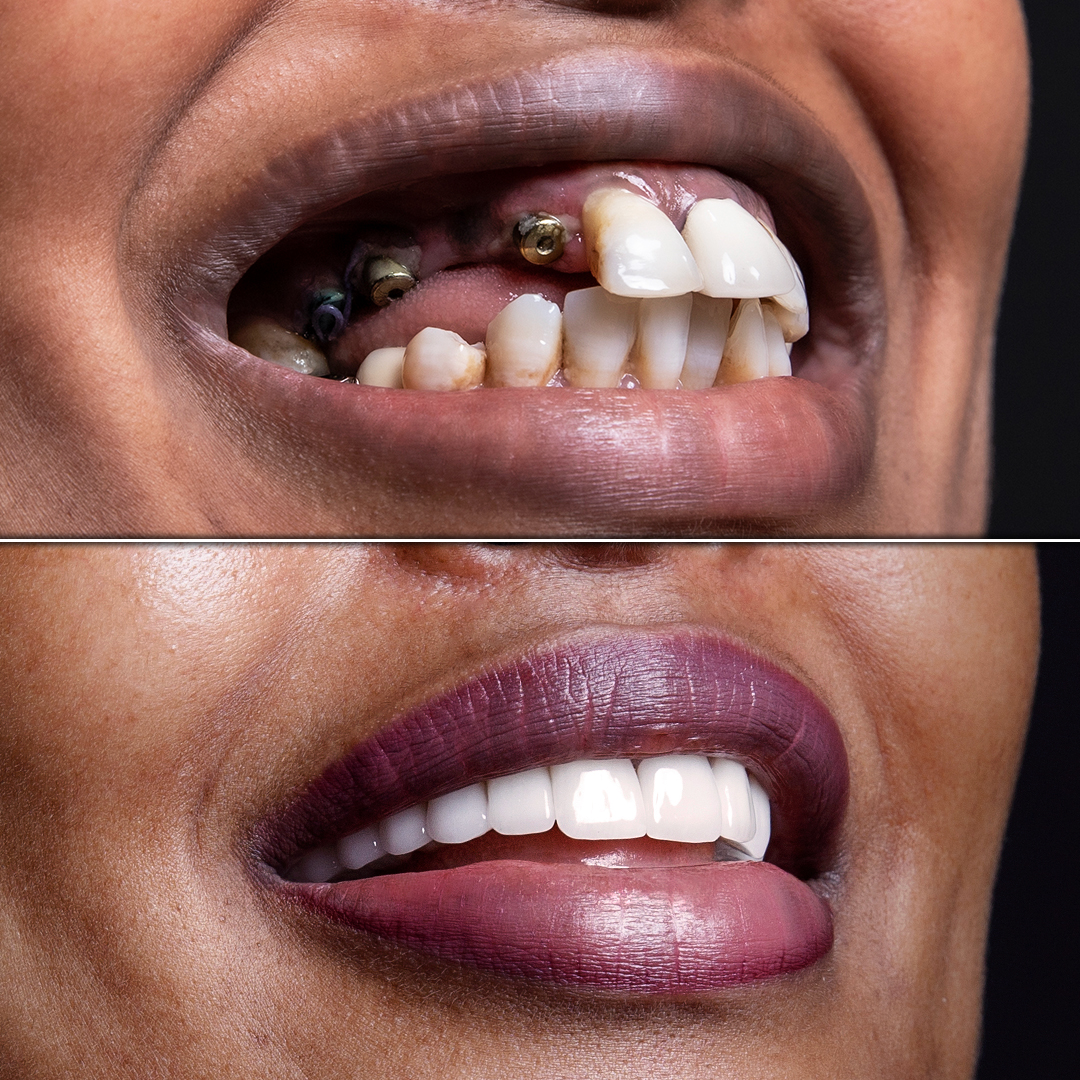 Severely decayed teeth restored with full-mouth dental implants in a female patient