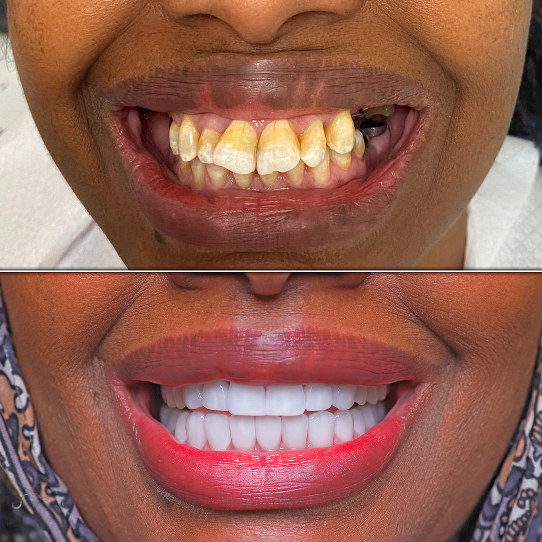 Discolored and crowded teeth corrected with smile design and dental implants