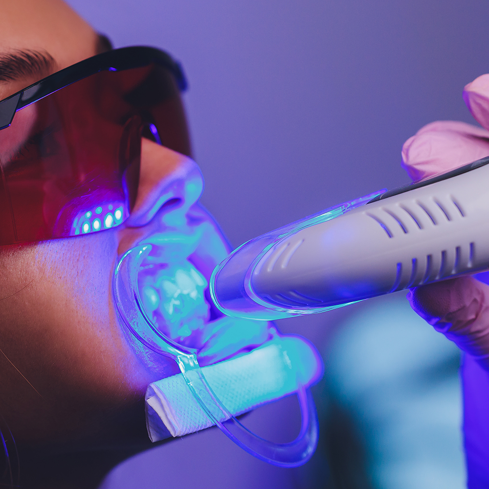 Laser beam device being used on patient for laser teeth whitening procedure