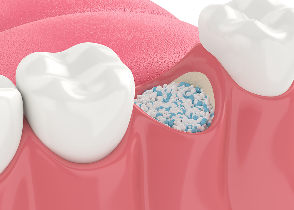 Close-up of a dental socket filled with granular bone graft material next to adjacent teeth.