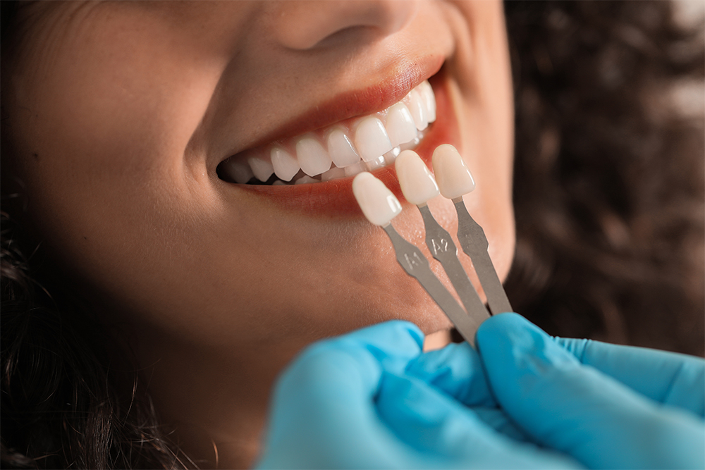 Dentist matching porcelain veneer shades to patient's teeth during cosmetic dental consultation at Natural Clinic