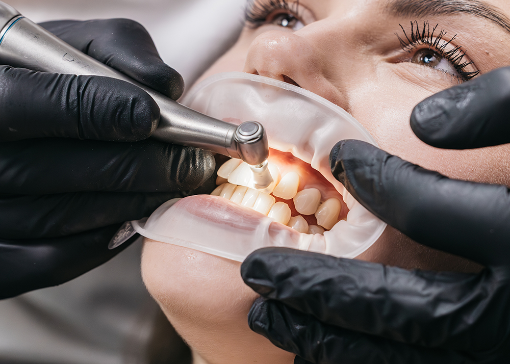 Dental cleaning with high-speed tool for advanced oral hygiene and plaque removal