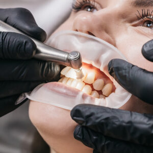 Teeth Whitening Methods: 7 Proven Differences Between In-Clinic and At-Home Treatments